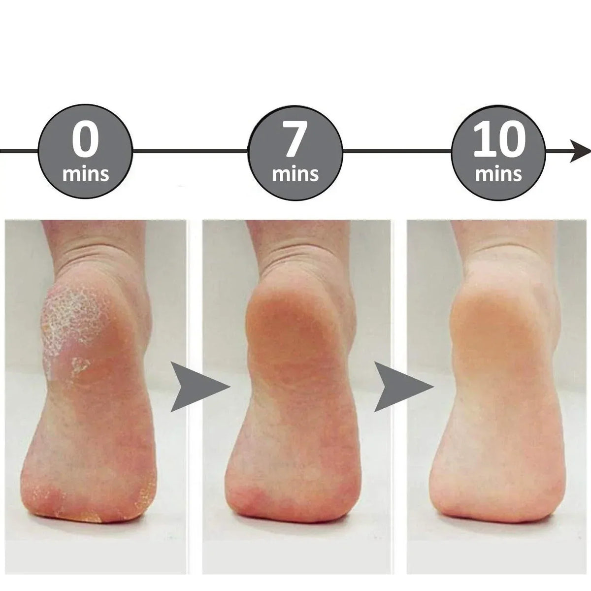 Foot File Callus Remover